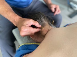 Dry Needling: An Effective Technique for Pain Relief and Muscle Rehabilitation
